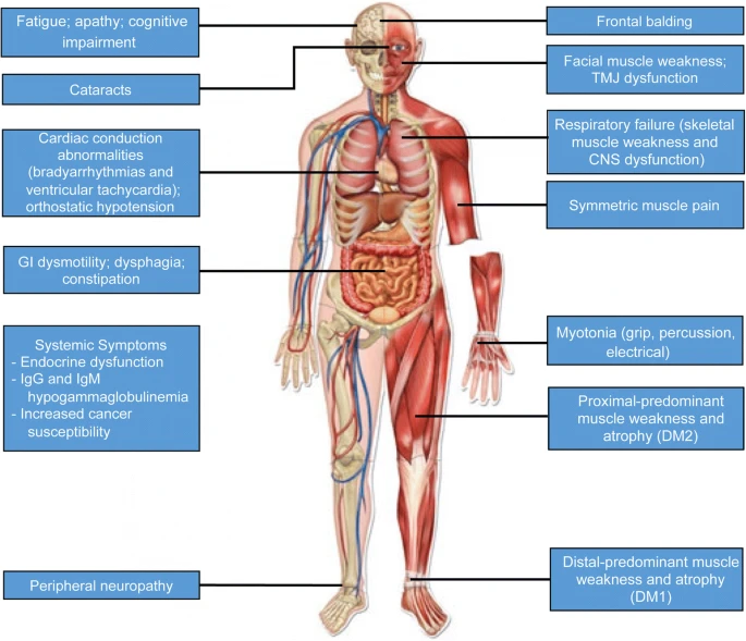 Diagram showing how Myotonic Dystrophy affects different parts of the body